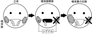 「口腔乾燥症の克服を目指して」
